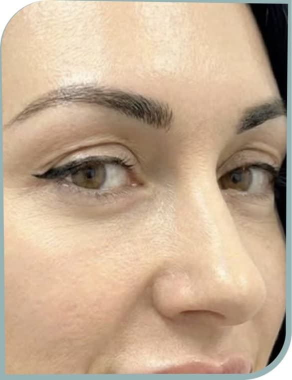 crow's feet eased, After photo (result 8 of 10)
