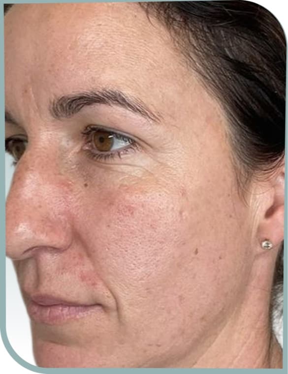 frown line softened, Before photo (result 9 of 10)