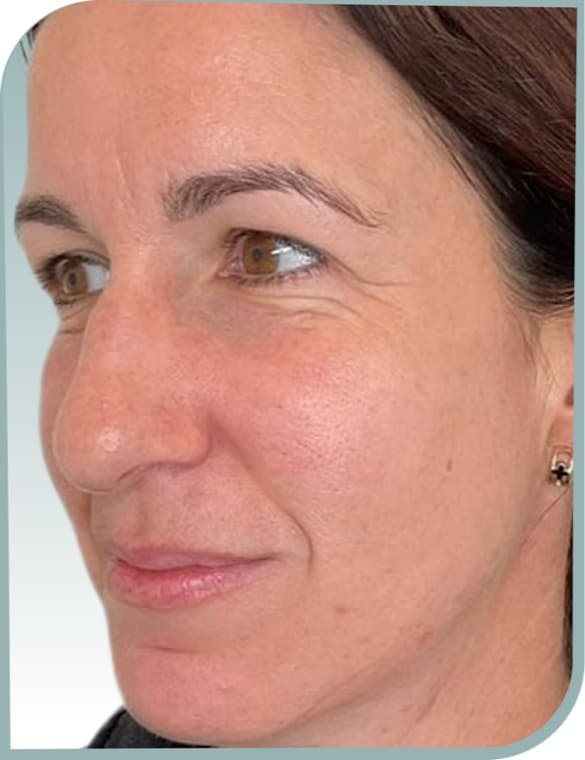 frown line softened, After photo (result 9 of 10)