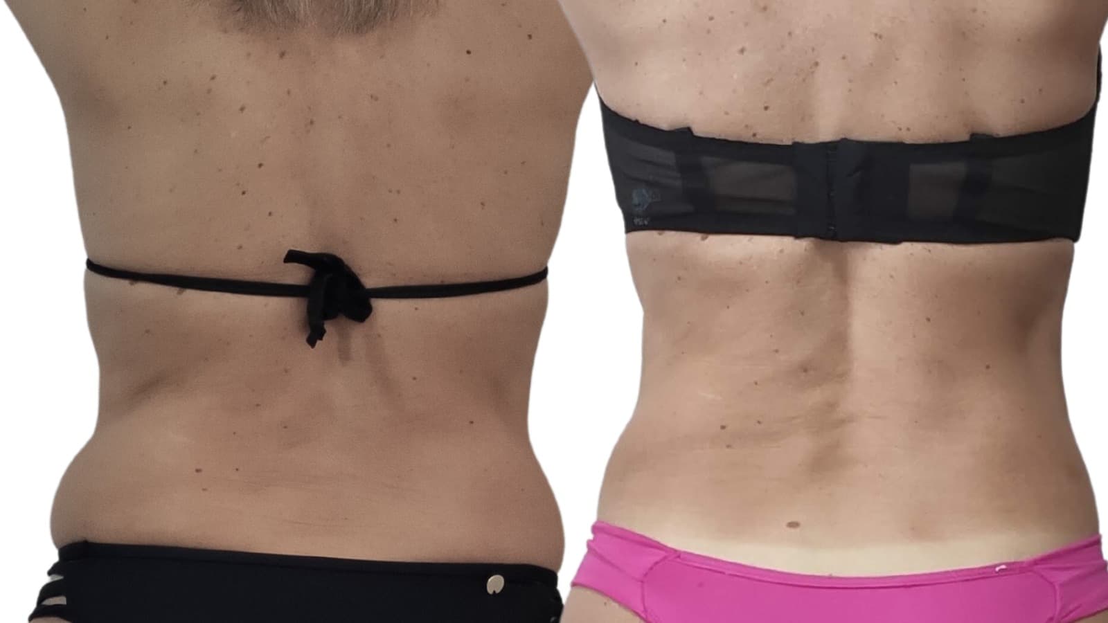 Non-Surgical: Achieve Your Summer Body Goals