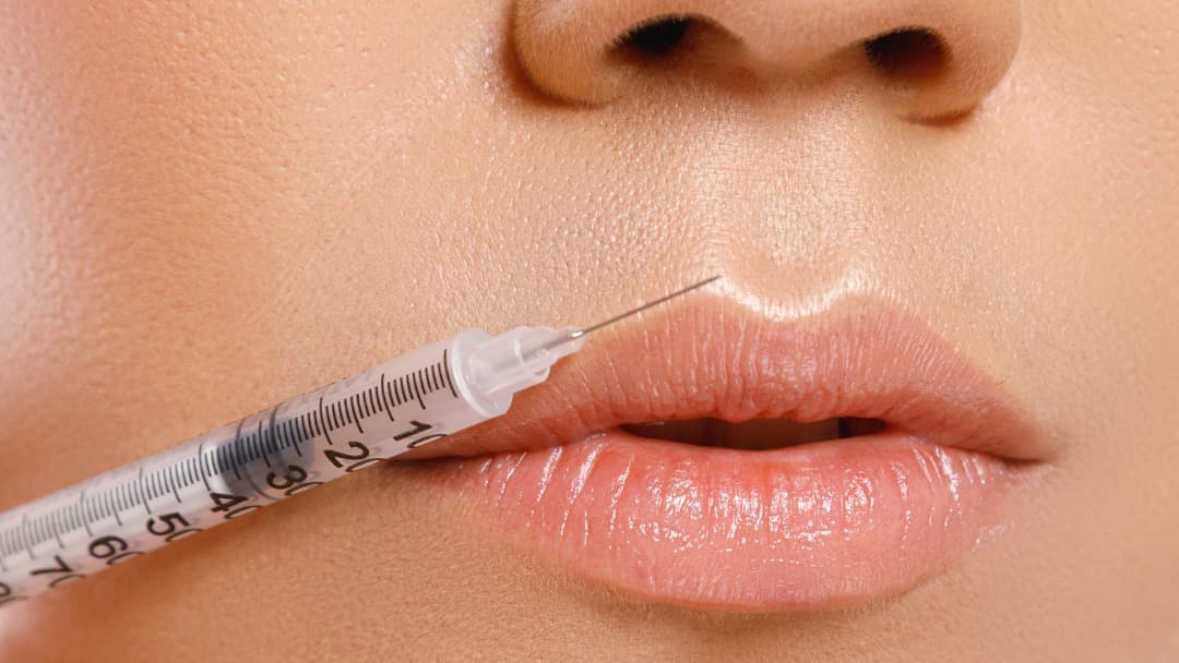 Natural Lip Fillers in Malta: What’s Trending This Year