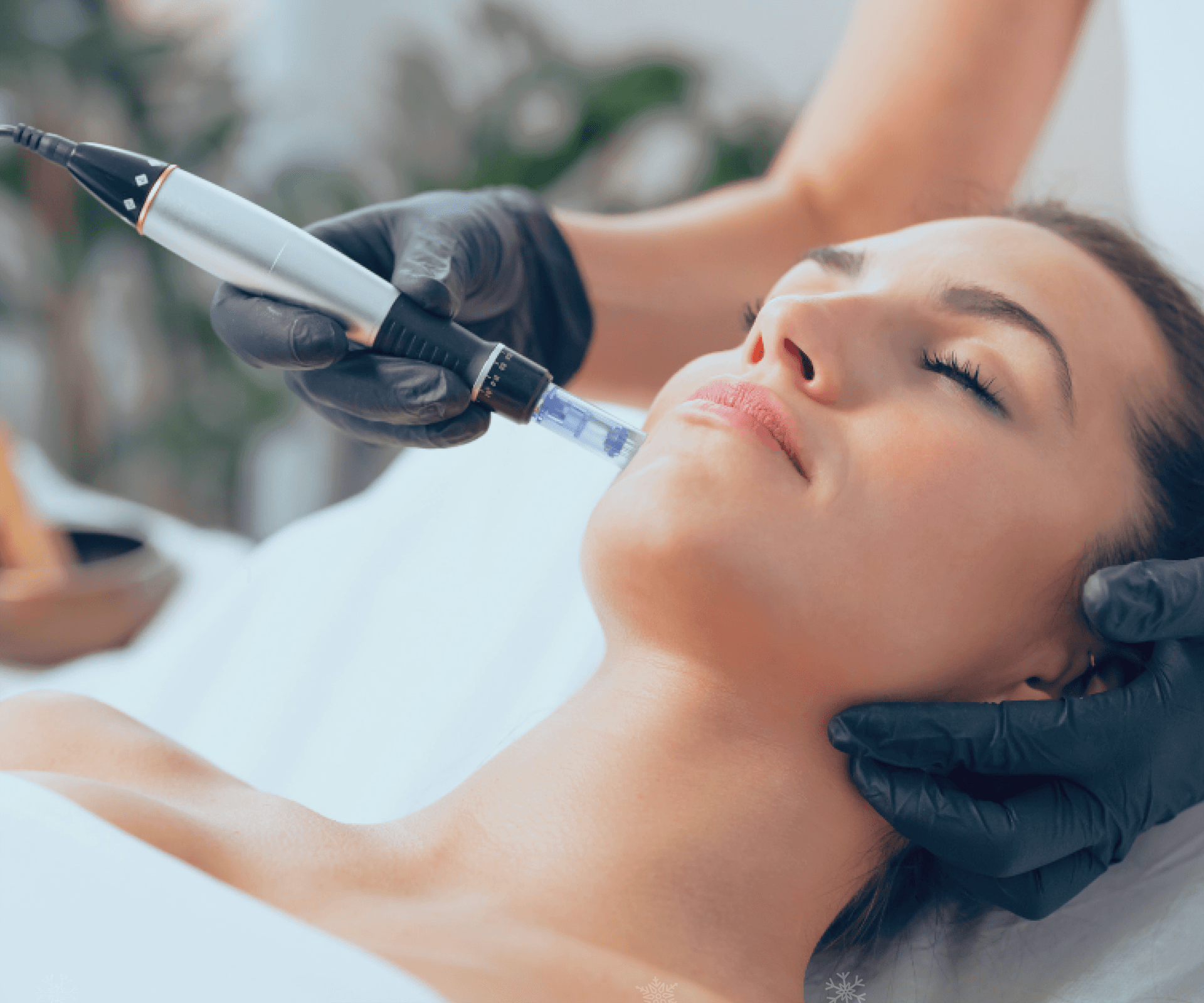 Microneedling This Summer: Yes or No?
